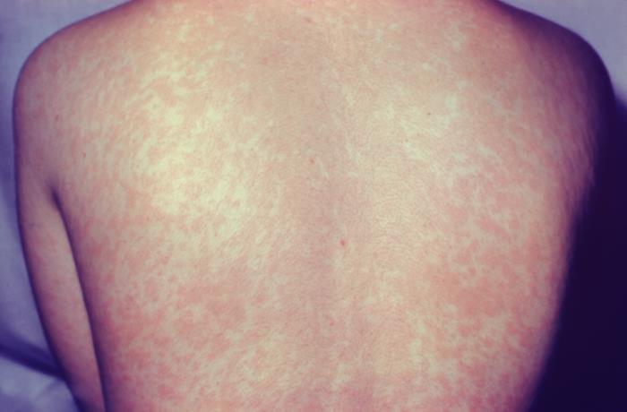 Afbeelding van rug van patiënt met mazelen